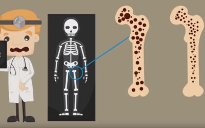 Osteoporosis.